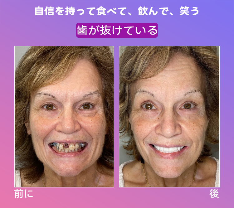 𝐉𝐚𝐬𝐬𝐞𝐞𝐦®🐼新世代の快適な義歯(🦷期間限定割引 残り30分🦷)