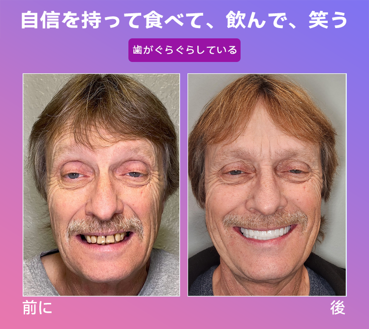 𝐉𝐚𝐬𝐬𝐞𝐞𝐦®🐼新世代の快適な義歯(🦷期間限定割引 残り30分🦷)