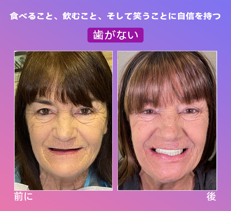 𝐉𝐚𝐬𝐬𝐞𝐞𝐦®🐼新世代の快適な義歯(🦷期間限定割引 残り30分🦷)