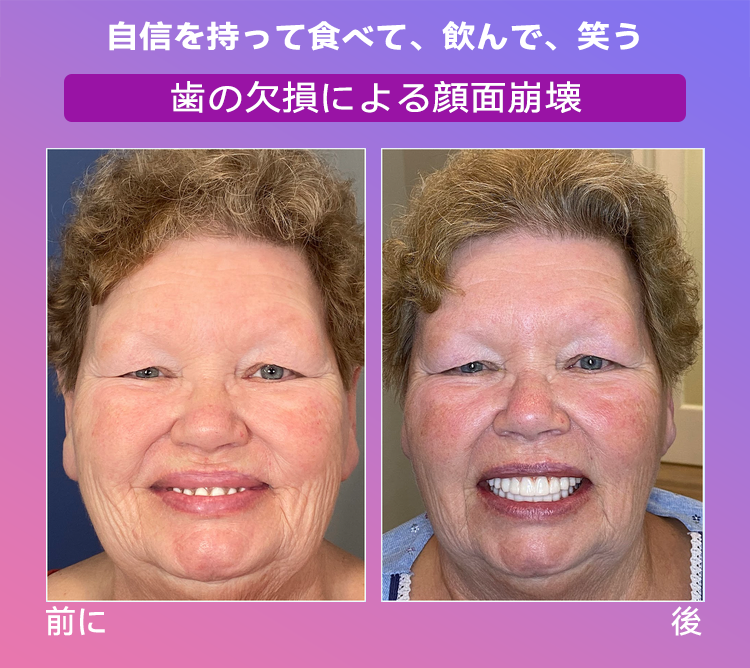 𝐉𝐚𝐬𝐬𝐞𝐞𝐦®🐼新世代の快適な義歯(🦷期間限定割引 残り30分🦷)